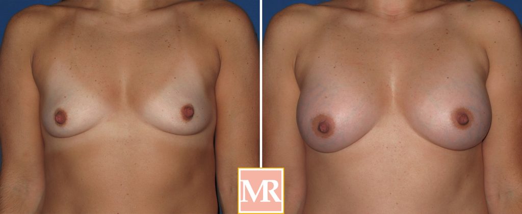 breast augmentation surgery results