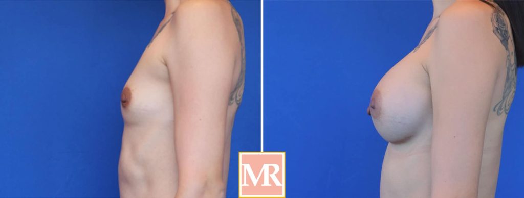 breast augmentation before and after 1