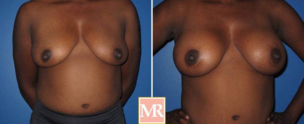 breast augmentation before after results