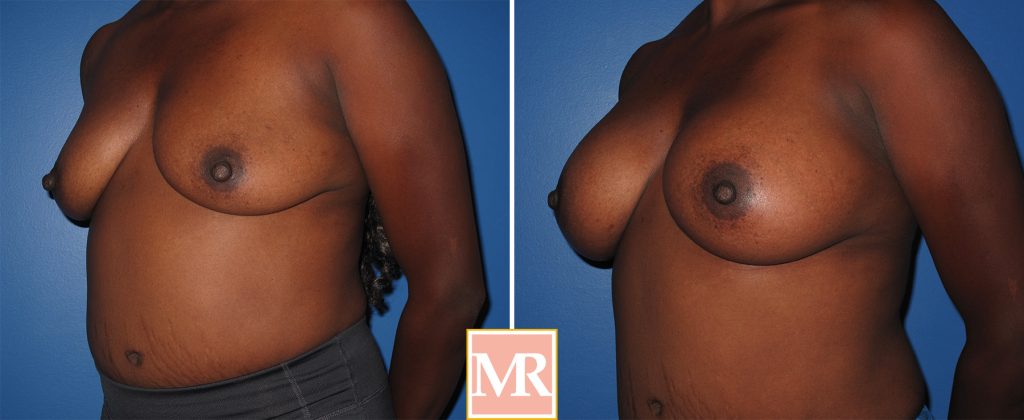 breast augmentation results before and after