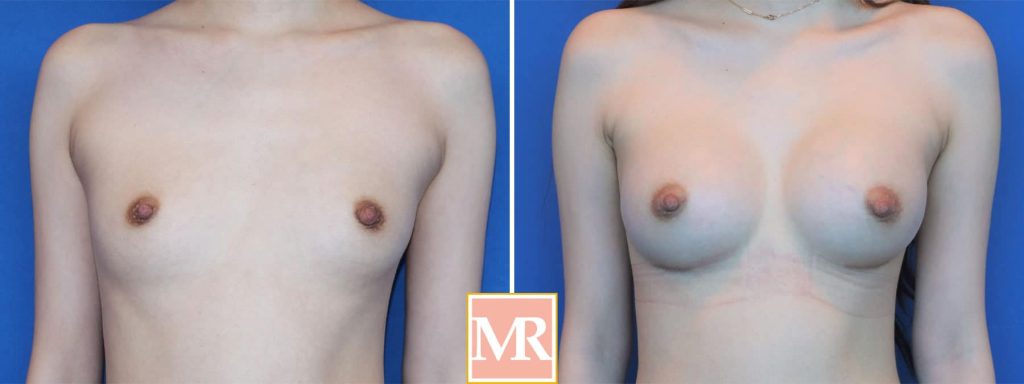 best breast implants before and after