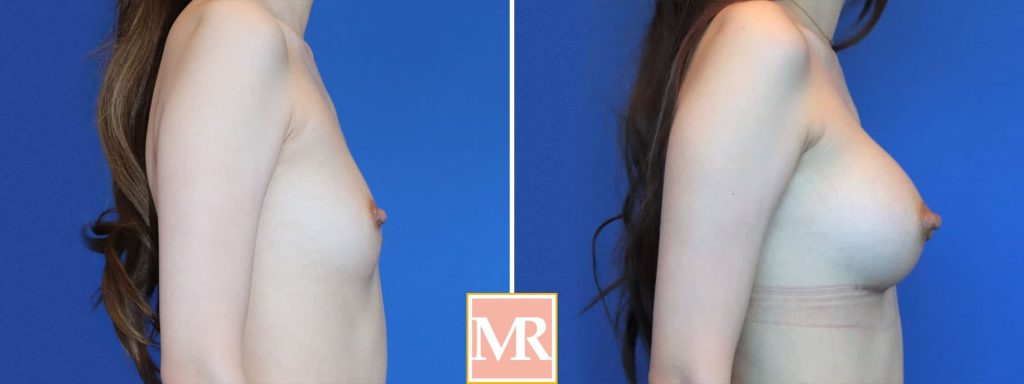 breast augmentation before after bh