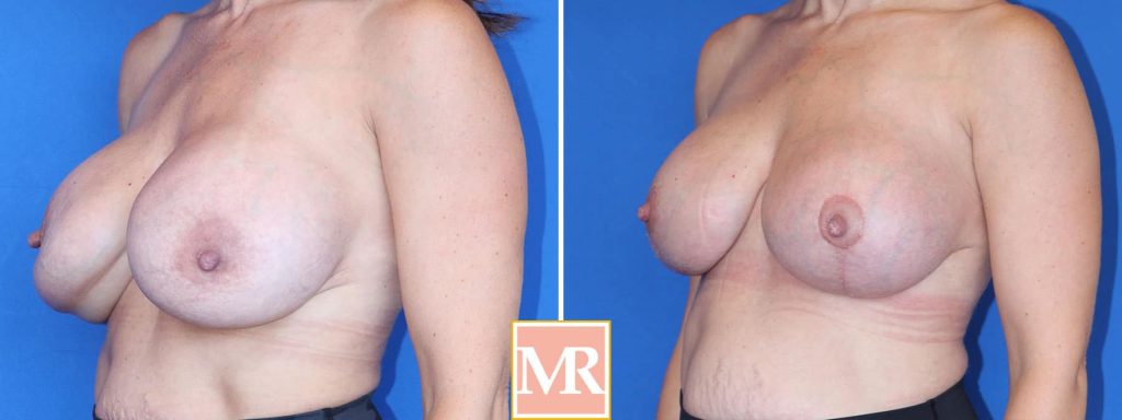 correct breasts before and after pics