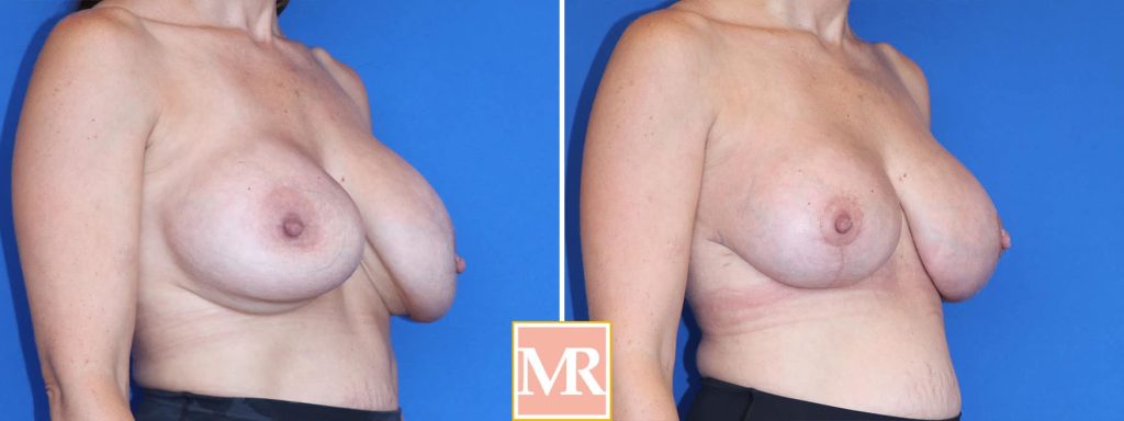 breast augmentation revision pics