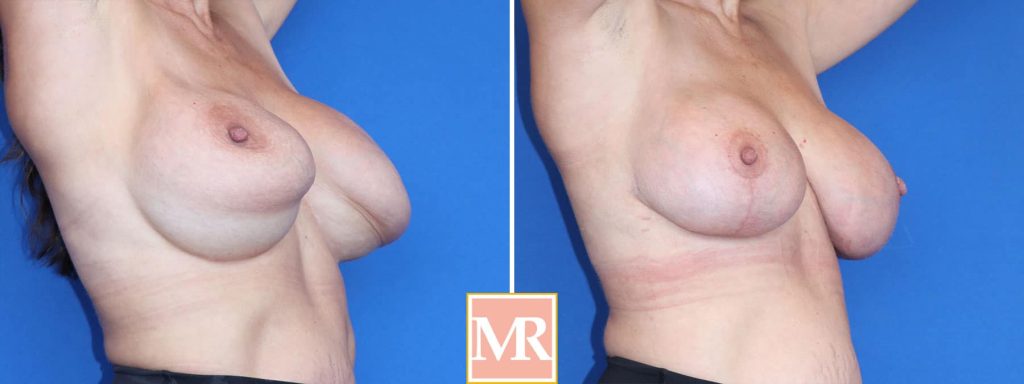 revision breast surgery image search results
