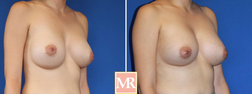 revision breast job before and after