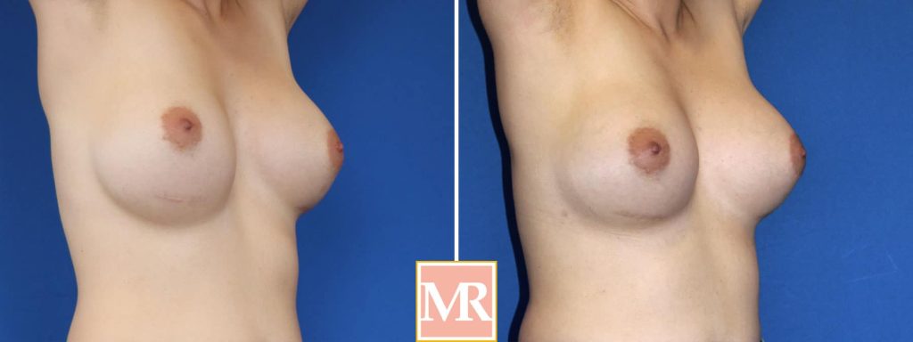 revision breast surgery results pics