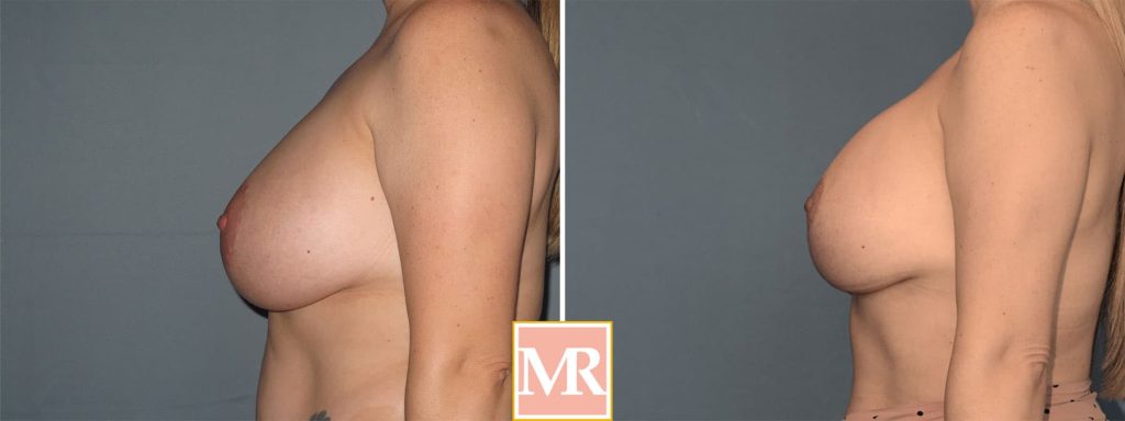 revision breast aug before and after results pics