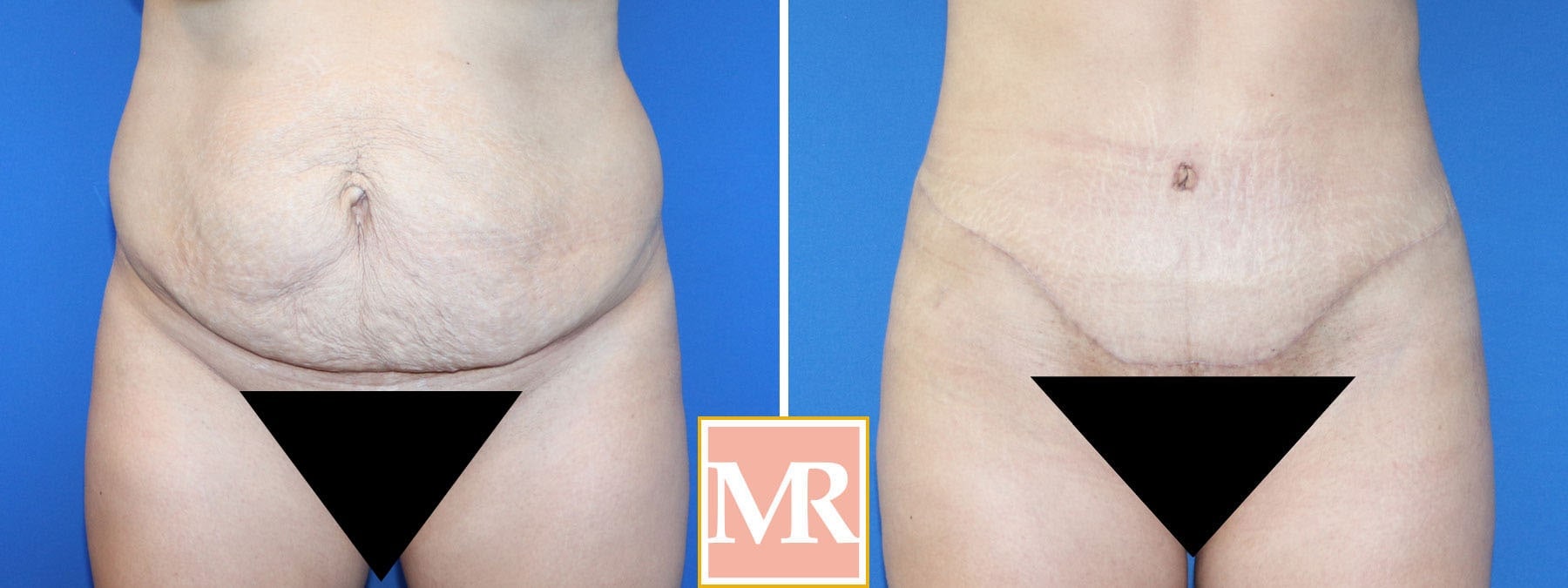 tummy tuck results millicent rovelo