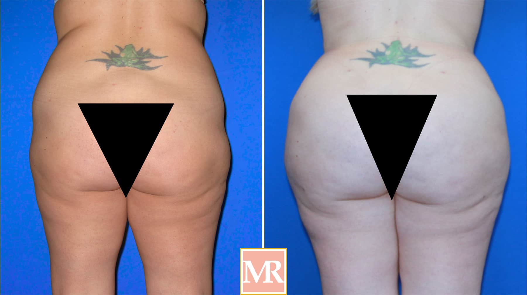 Brazilian Butt Lift Before and After Beverly Hills - Millicent Rovelo MD