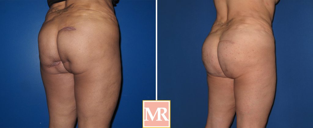 buttock reconstruction before and after