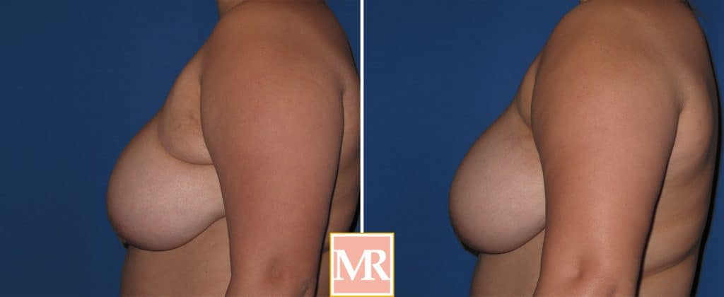 ectopic breast before after pics