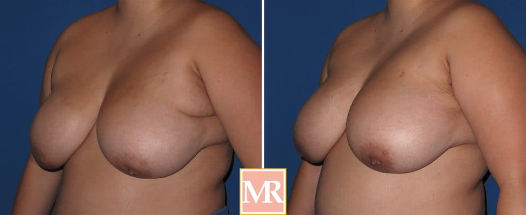 ectopic breast before after