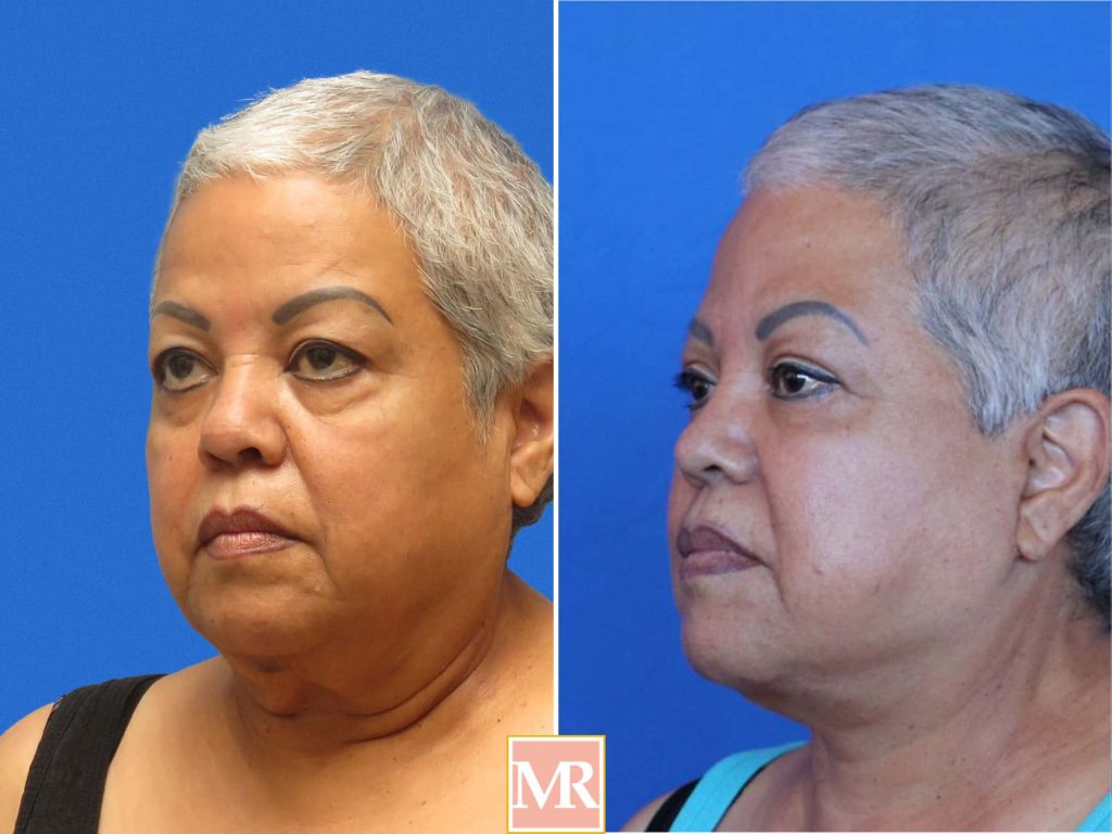facelift before and after pics beverly hills