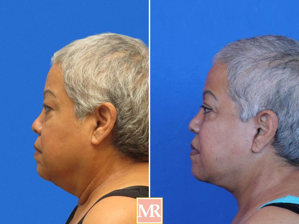 facelift before and after results