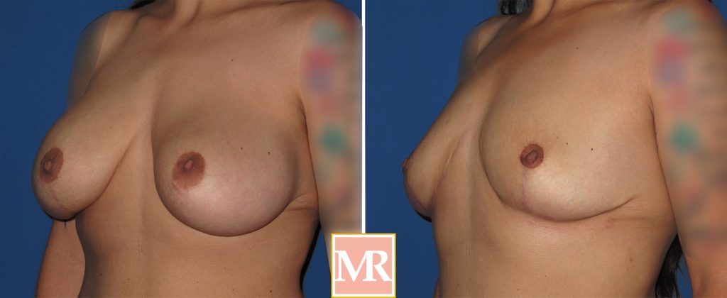 implant removal before after photo pics