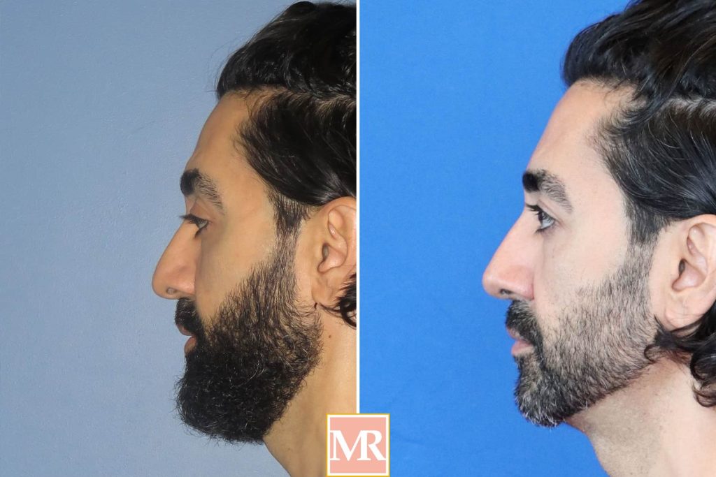 rhinoplasty before after results