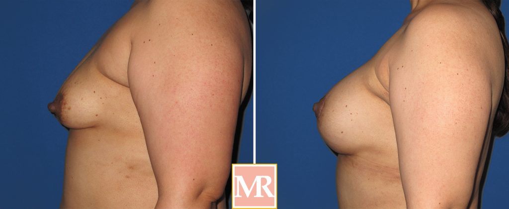 tuberous breast before and after results