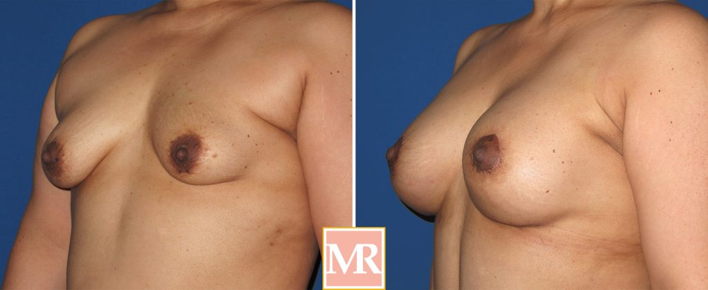 tuberous breast before and after