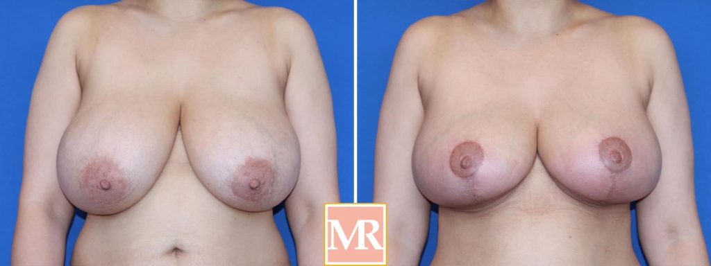 designer breast reduction dr. rovelo