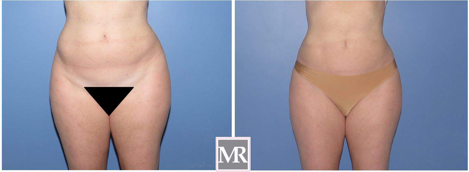 lipo instead of tummy tuck