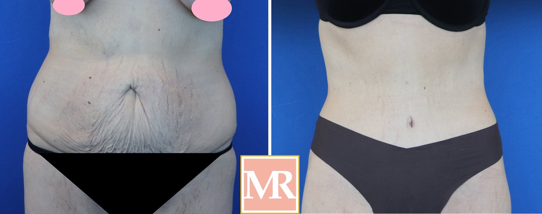 tummy tuck vs liposuction