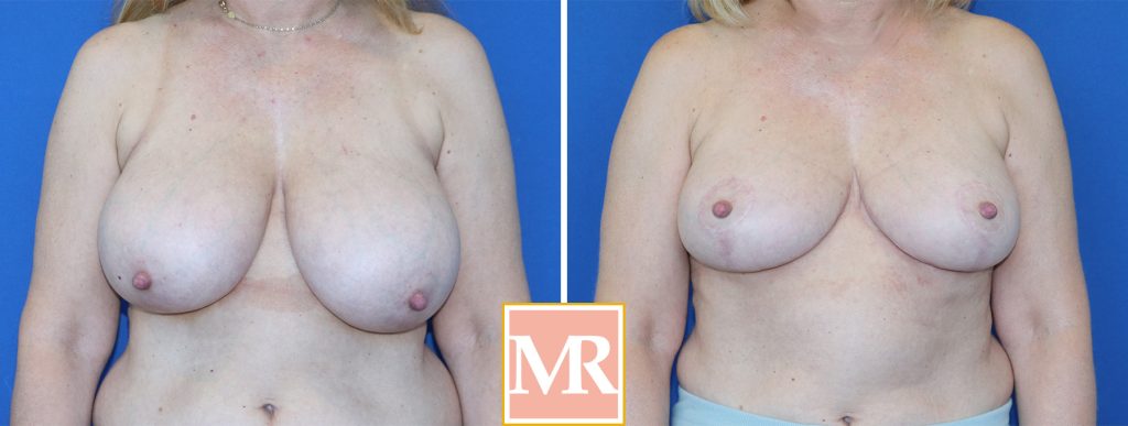 sizing breast reduction size chart